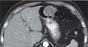 Crean en Italia microchip detector de traumas y tumores cerebrales