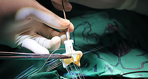 Primer trasplante de pulmn tras COVID19 a partir de donantes vivos