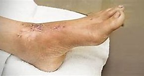 Crean parche drmico capaz de eliminar infecciones en pie diabtico