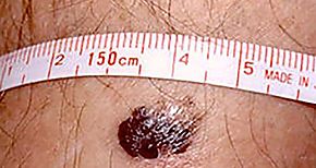 Desarrollan un software que agiliza la deteccin del melanoma