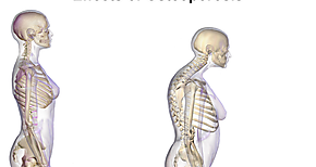 Osteoporosis enfermedades de viejos