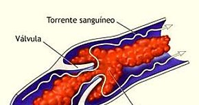 Panam relaciona la trombosis como una de las principales razones de muerte en enfermedades no transmisibles