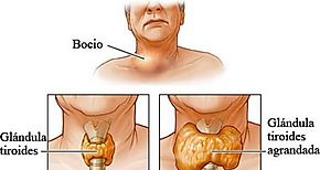 Aprenda a prevenir el tiroides 