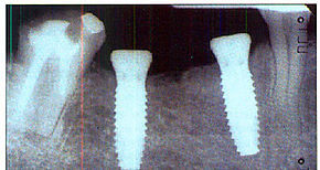 Mejoran biocompatibilidad de implantes de titanio