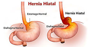 Las hernias ms comunes se desarrollan en el abdomen 