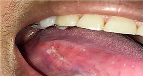 Conoce ms sobre el cncer bucal 
