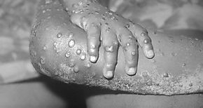 ONU expresa preocupacin por aumento de casos de mpox en frica