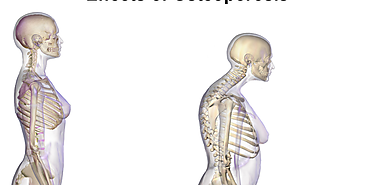 Da Mundial de la Osteoporosis