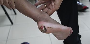 Pie diabtico y venas varicosas problema en aumento en la poblacin