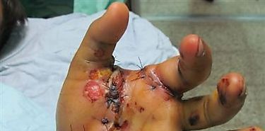 Evitar las quemaduras en nios es responsabilidad de todos