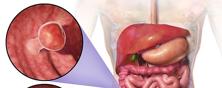 Da Mundial Contra el Cncer de Colon