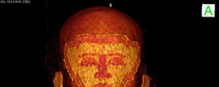 Un TAC realizado a momia egipcias identifica el caso ms antiguo de cncer de mama
