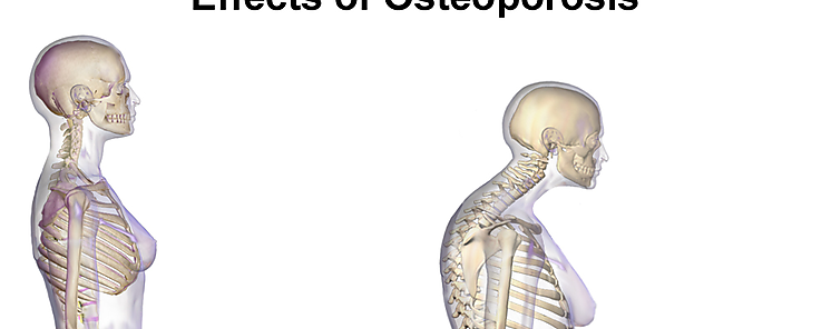 Factores que pueden aumentar el riesgo de padecer osteoporosis