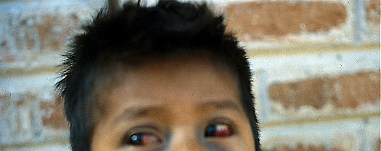 9 defunciones por tosferina en la Comarca de Ngabe Bugl