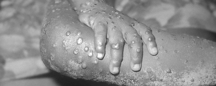 ONU expresa preocupacin por aumento de casos de mpox en frica