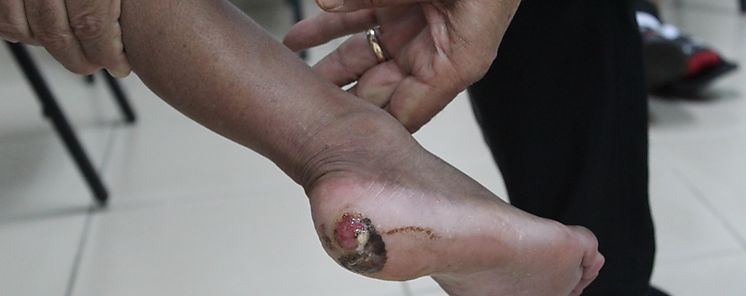 Pie diabtico y venas varicosas problema en aumento en la poblacin