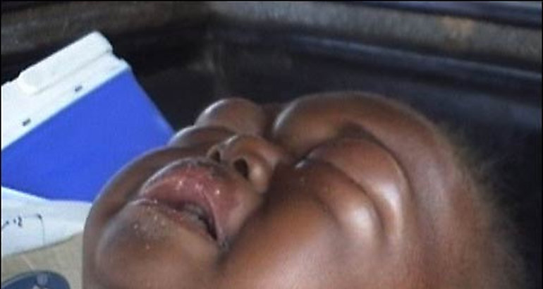 Malaria