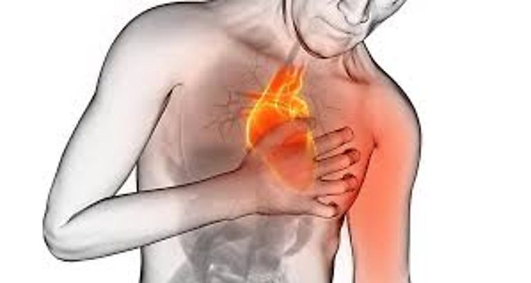 Infarto