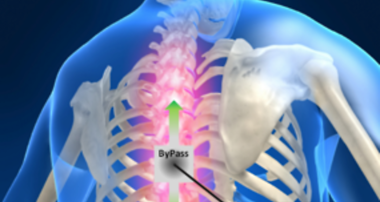 Bypass para lesiones medulares