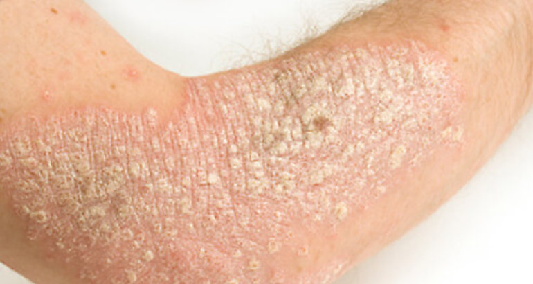 psoriasis