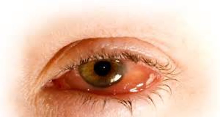 conjuntivitis