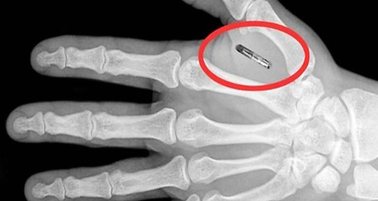 microchips 