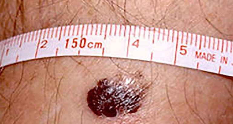 melanoma