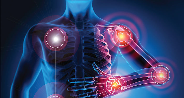 Artritis Reumatoide