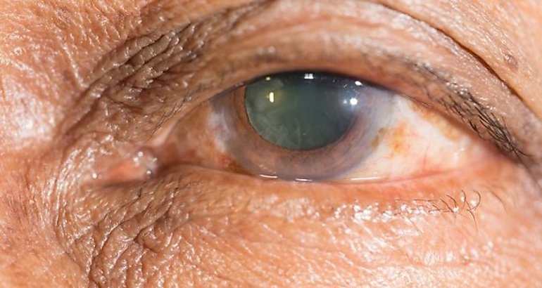 El glaucoma
