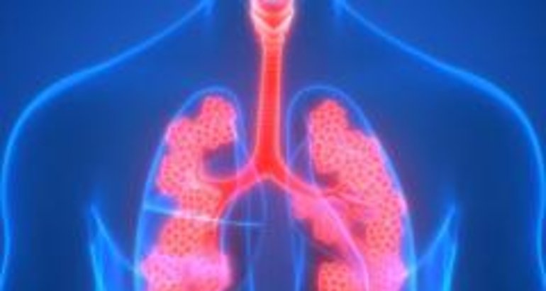 Pacientes de EPOC avanzan exitosamente tras primer ao de uso de novedosa vlvula pulmonar 